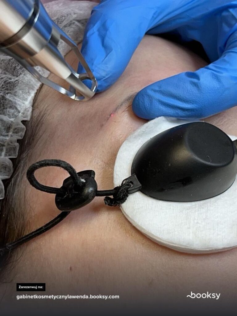 Laserowe usuwanie tatuażu i makijażu permanentnego